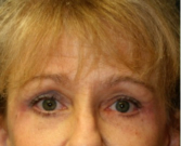 Feel Beautiful - Browlift case 101 - After Photo